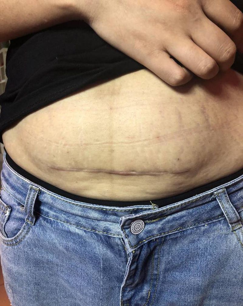 遮盖剖腹产疤痕纹身图片_腹部纹身图案