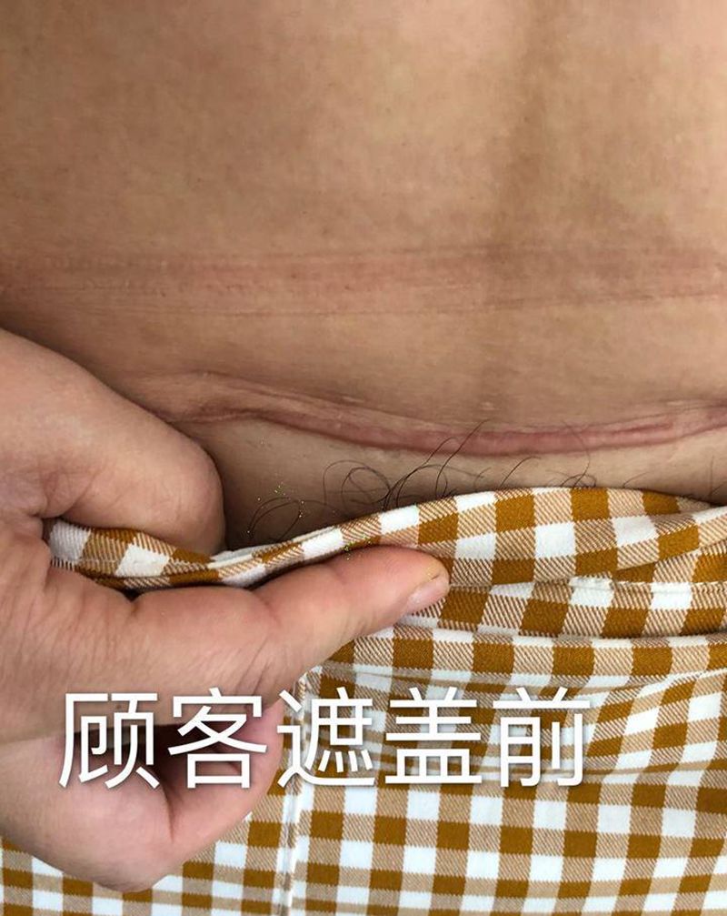 遮盖顾客抛妇产手术疤纹身图片_腹部纹身图案