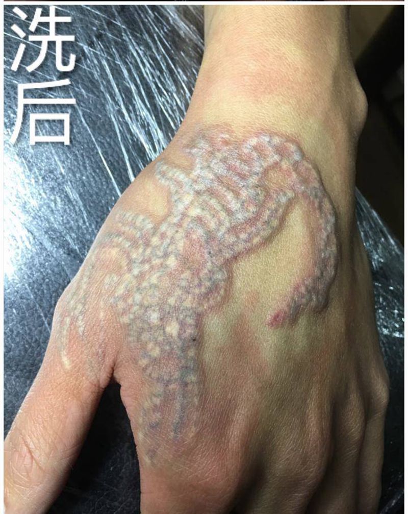超皮秒清洗第一次纹身图片_手部纹身图案