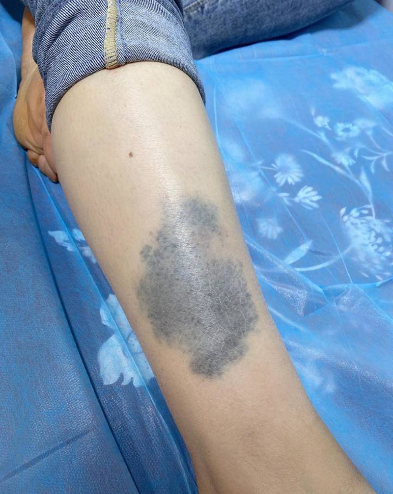 胎记遮盖纹身图片_腿部纹身图案